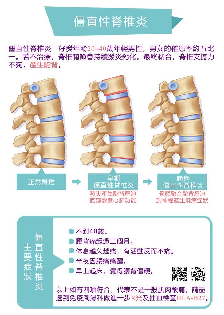 僵直性脊椎炎.jpg