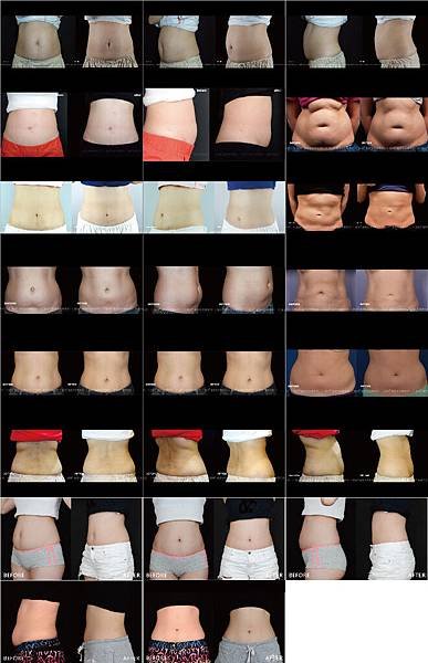 CoolSculpting-Other-02