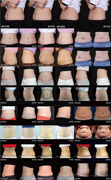 Coolsculpting-Other