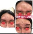 注射填充額頭不滿意還可以做額頭墊片嗎？