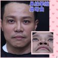 臉部重修手術