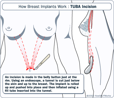 breast-implant-tuba.gif