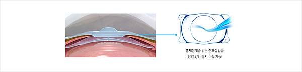 ICL植入式微型鏡片－EVO+ ICL(V5 ICL)