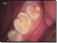16齲齒治療中1