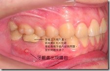 46牙齦出現膿包。