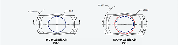 ICL植入式微型鏡片－EVO+ ICL(V5 ICL)