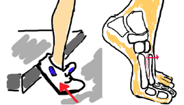 lisfranc+fracture+metatarsal+broken+foot+diagnosis -1.png