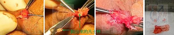 陰莖凡士林/石蠟注射(The vaseline/paraff