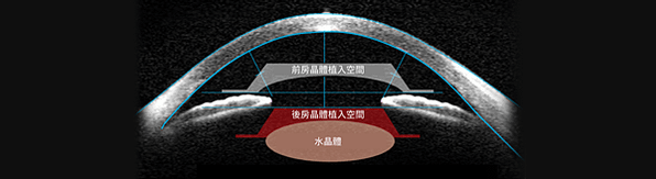 ICL植入式微型鏡片－EVO+ ICL(V5 ICL)