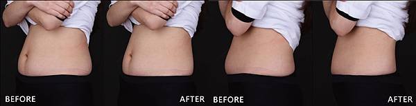 Coolsculpting-dodo-ba