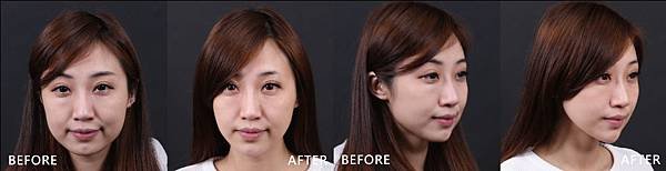 Botox+doublo-Tashaba