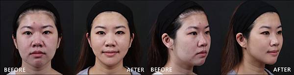 V-LOC+Hyaluronic-Ying-ba