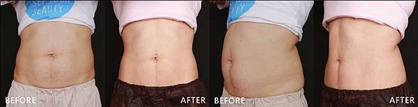 CoolSculpting-Sunny-B-a