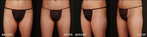 CoolSculpting-Madison-ba