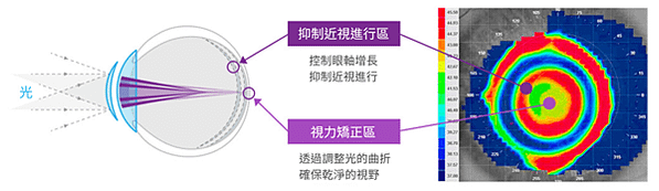 兒童近視控制日拋隱形眼鏡－MiSight