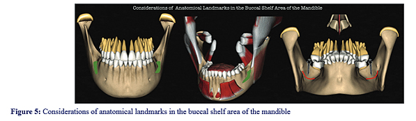 @齒顎矯正每日一說~~0225 buccal shelf m