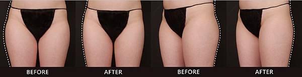 Miss Ko-Coolsculpting-ba