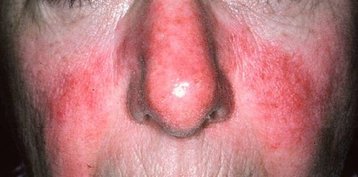 rosacea 1.jpg