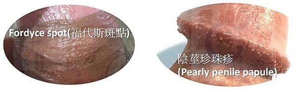 Fordyce spot(福代斯斑點) VS 陰莖珍珠疹(Pearly penile papule)_0.jpg