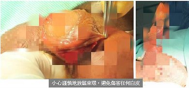 包皮異常 – 海豚外型的增生性陰莖皮膚(Hypertroph