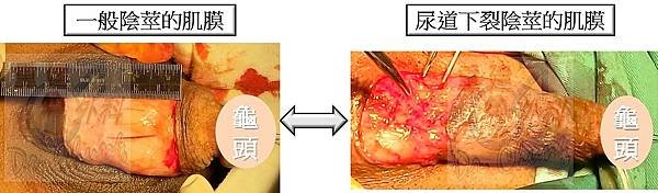 肌膜的不同-一般陰莖vs尿道下裂陰莖.jpg