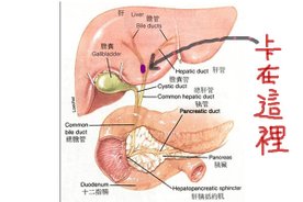 膽管結石位置圖.jpg