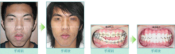 謝明吉;謝明吉醫師;正顎手術