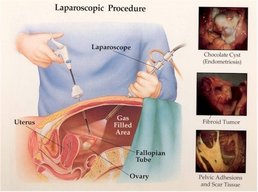 tubal_disease_ls_view.jpg