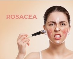 酒糟性皮膚炎 玫瑰斑 ROSACEA