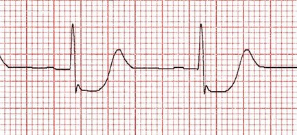 ST-segment-V2-PMI.jpg