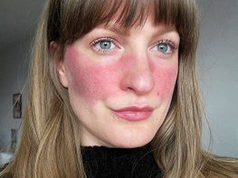 酒糟性皮膚炎 玫瑰斑 ROSACEA