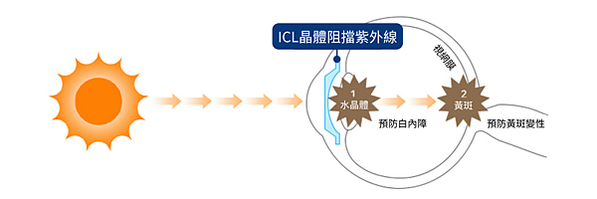 ICL植入式微型鏡片