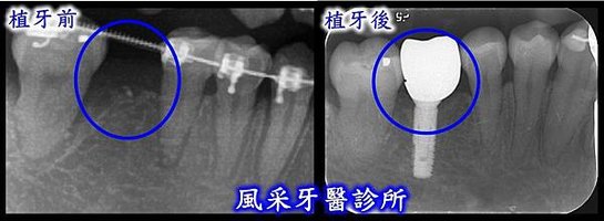 值牙前後比較