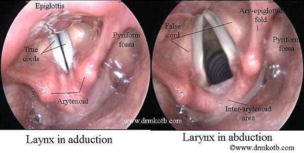 normal endoscopic view of the larynx.jpg