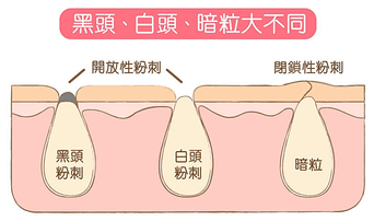 暗瘡、油脂粒同我速速消失！