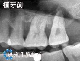 楊先生植牙前-X