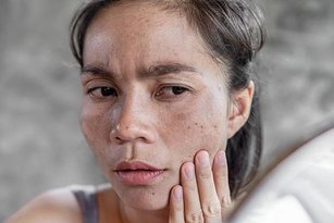 asian-woman-having-skin-dark-spot-freckle-from-uv-light_34670-805.jpg
