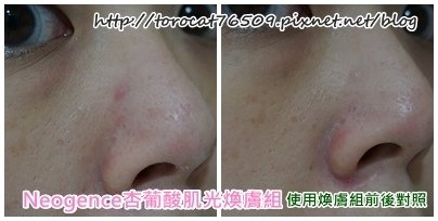 Neogence杏葡酸肌光膚組-使用七天前後照2.jpg
