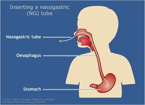 nasogastric-tube-RCH-KHI500.jpg