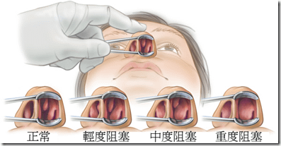 turbinate hypertrophy