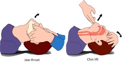 chin lift en jaw thrust.jpg