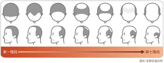 掉髮治療、大量掉髮原因、掉髮怎麼辦、大量掉髮看哪科、嚴重掉髮要看哪一科、突然掉髮嚴重、異常掉髮原因、禿頭原因、遺傳禿頭解決03.jpg