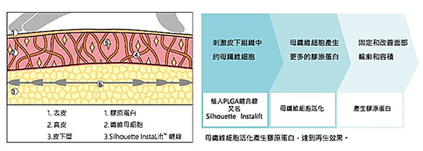 塑立愛立提線　打擊下垂臉困擾