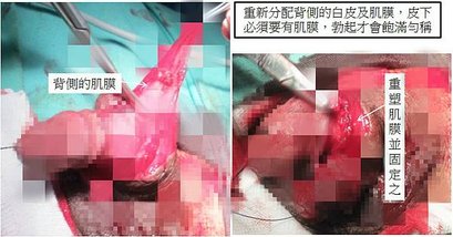 包皮異常 – 海豚外型的增生性陰莖皮膚(Hypertroph