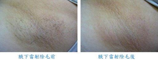 腋下雷射除毛