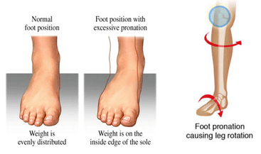 over-pronation-pilates-helps-knee-pain.png