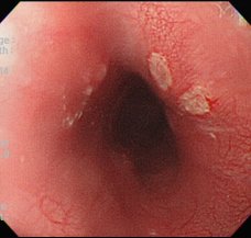 Esophageal ulcer