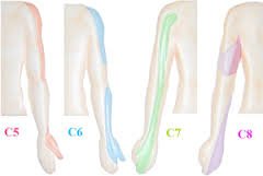 C5-C8 神經壓迫