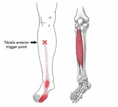 TA trigger-points 01.jpg