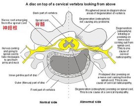 httpswww.physio-pedia.comimages22bCervial-radiculopathy.jpg